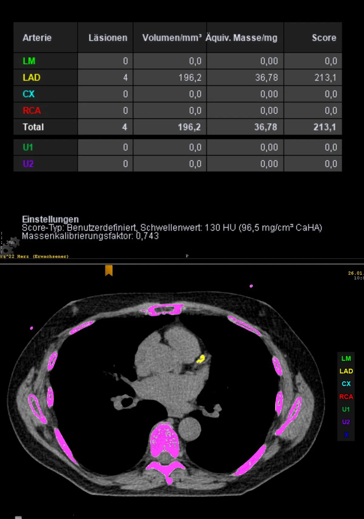 A calcium scoring workstation report: a table listing lesion counts, volume and score for each coronary artery, above an axial chest CT slice in which calcified deposits are highlighted in bright colour