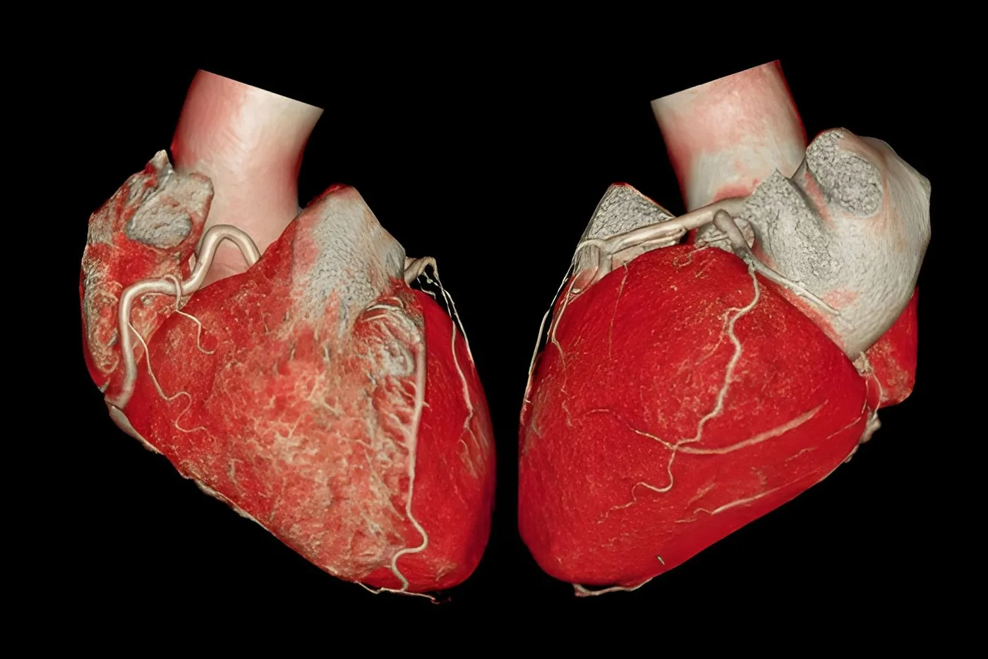 Two volume-rendered cardiac CT views of a human heart, the muscle in deep red with the coronary arteries standing out in pale relief against a black background