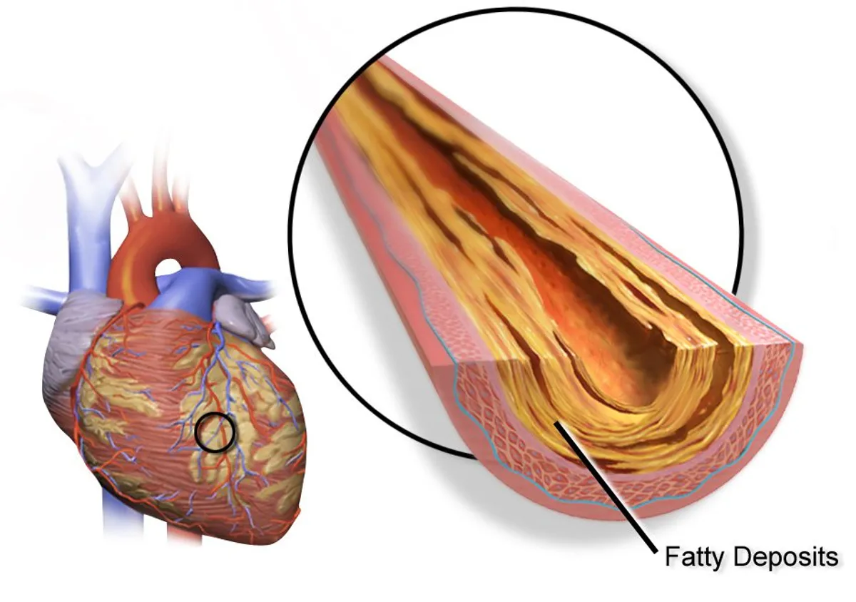 Medical illustration of a heart with one coronary artery circled, magnified alongside to show yellow fatty deposits thickening the vessel wall and narrowing the channel through it